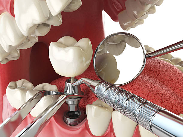 Best Emergency Wisdom Teeth Removal in Lake Lorelei, OH